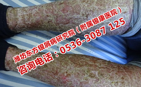 銀屑病加重的元兇