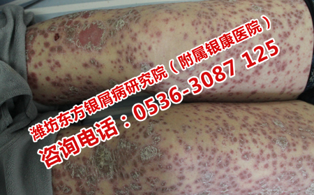 膿皰性銀屑病如何消除