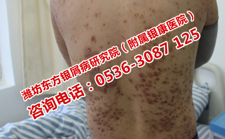 濰坊東方銀屑病研究院正規治療