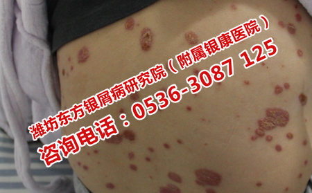 輕微的尋常性銀屑病如何治療