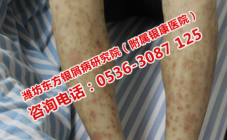 輕微的尋常性銀屑病治療