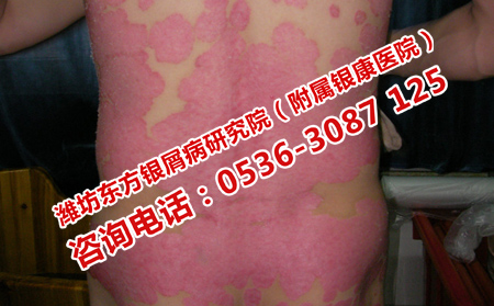 紅皮型銀屑病致命嗎