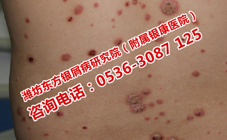 銀屑病可以了又犯的原因