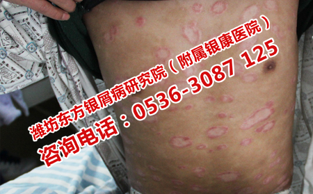 干冷冬季護理銀屑病