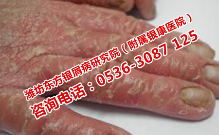 如何控制關節型銀屑病