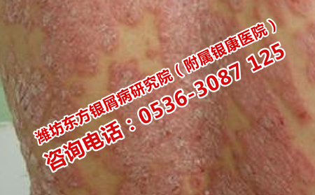 大雪期間護(hù)理嚴(yán)重銀屑病