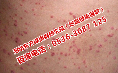 銀屑病治療真相