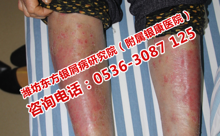 銀屑病患者不同季節護理自己的身體