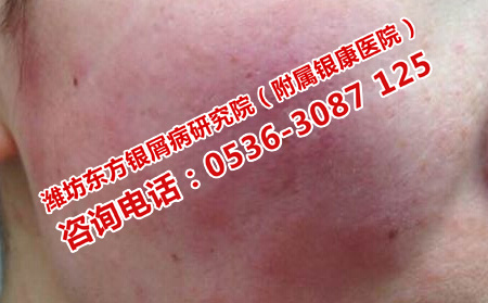 面部銀屑病如何護理