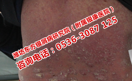 如何抑制紅皮型銀屑病反復