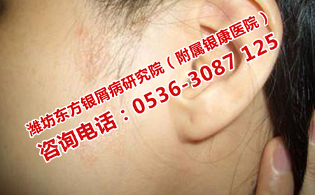 牛皮癬哪里能好的