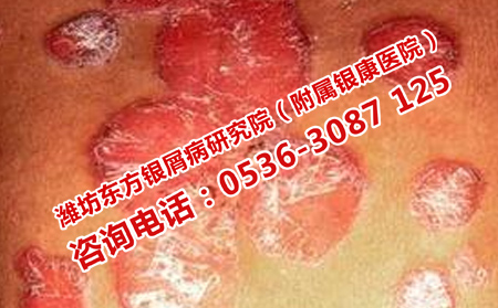 如何醫治冬季銀屑病