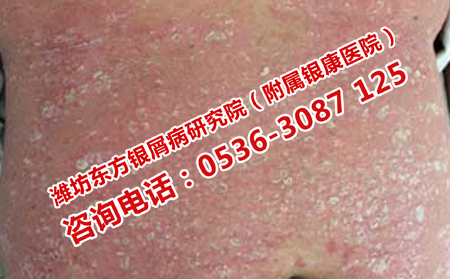 冬季銀屑病護理妙招