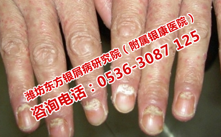 銀屑病關(guān)節(jié)炎與甲損害的關(guān)系