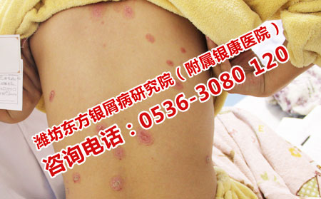 不嚴(yán)重的銀屑病還要看醫(yī)生嗎