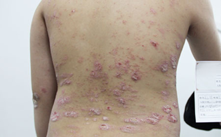如何臨床治療銀屑病