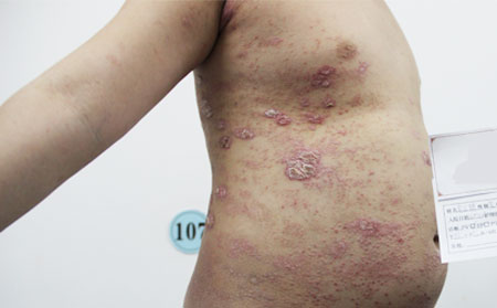 膿皰性銀屑病的護理