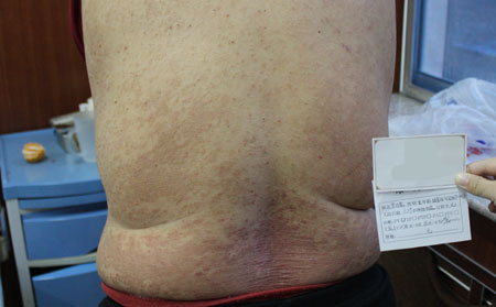 中醫治銀屑病的療程