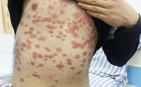 中醫(yī)解析膿皰性銀屑病
