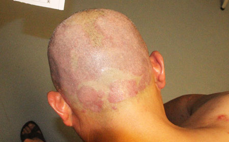 銀屑病造成的心理障礙