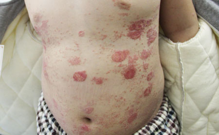 銀屑病患者預(yù)防藥物的毒副作用