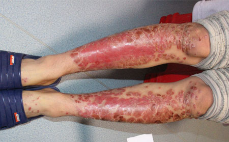 紅皮型銀屑病患者退燒