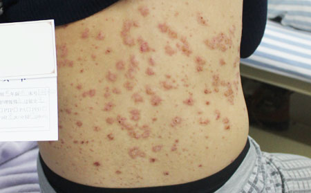 牛皮癬快好的時候為什么癢癢