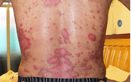 銀屑病長滿全身的7原因