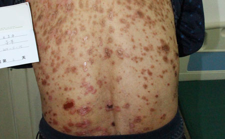 如何預(yù)防銀屑病復(fù)發(fā)