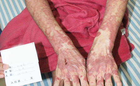 如何了解銀屑病的病情