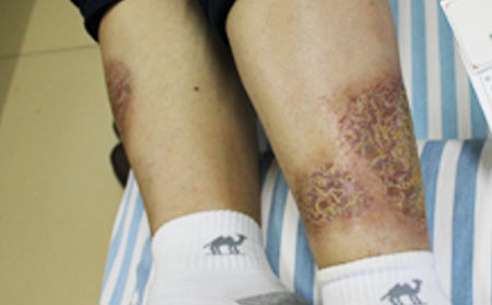 銀屑病治療與護(hù)理結(jié)合