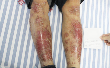 如何預防銀屑病復發(fā)