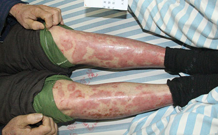 如何要銀屑病可以得快