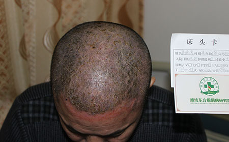 銀屑病患者嗓子疼怎么辦