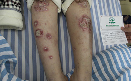 銀屑病治療的目標是什么