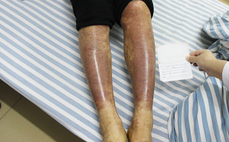 關(guān)節(jié)型銀屑病防護(hù)的專業(yè)措施