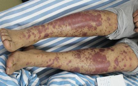 關節型銀屑病隔代遺傳