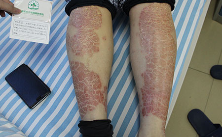 尋常性銀屑病的其他類型