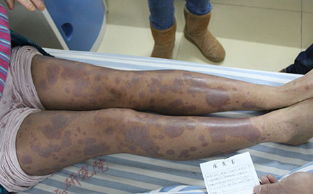 膿皰性銀屑病的科學調養(yǎng)