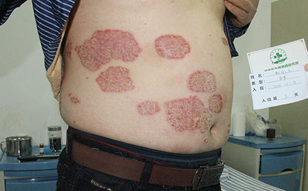 區分銀屑病與毛發紅糠疹