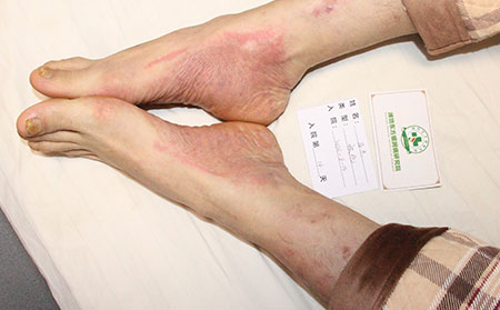 銀屑病早期的癥狀什么樣