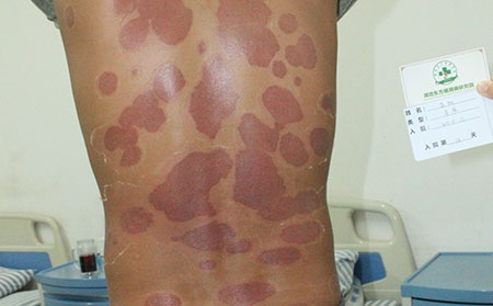 護理銀屑病皮膚的辦法有哪些