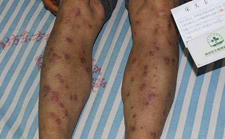 銀屑病發病的原因是什么