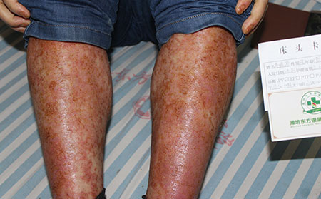 用藥期間的銀屑病護(hù)理