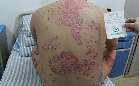 我的銀屑病治不可以是為何