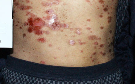 解釋為何銀屑病老是復發