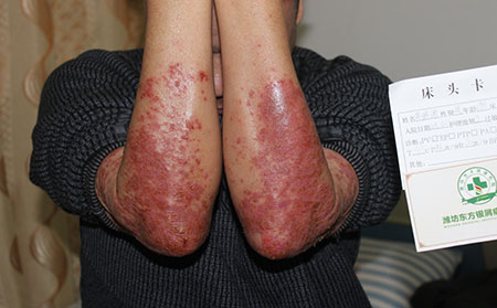 牛皮癬可以轉的癥狀有哪些