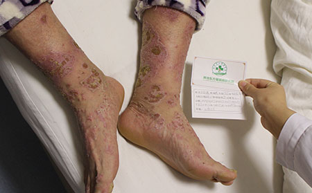 銀屑病可以后留下印的原因