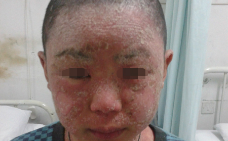 尋常性銀屑病會讓頭發(fā)減少嗎