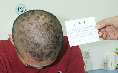 頭部銀屑病春季加重